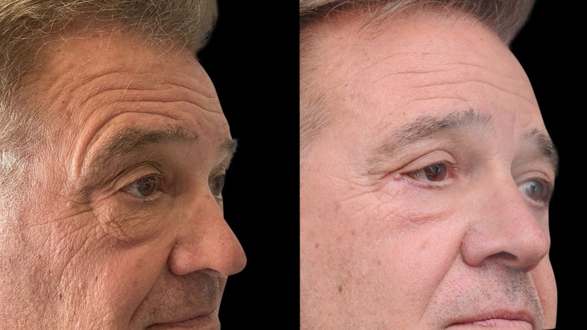 Upper & Lower Eyelid Surgery Before & After Gallery - Patient 147620 - Image 4