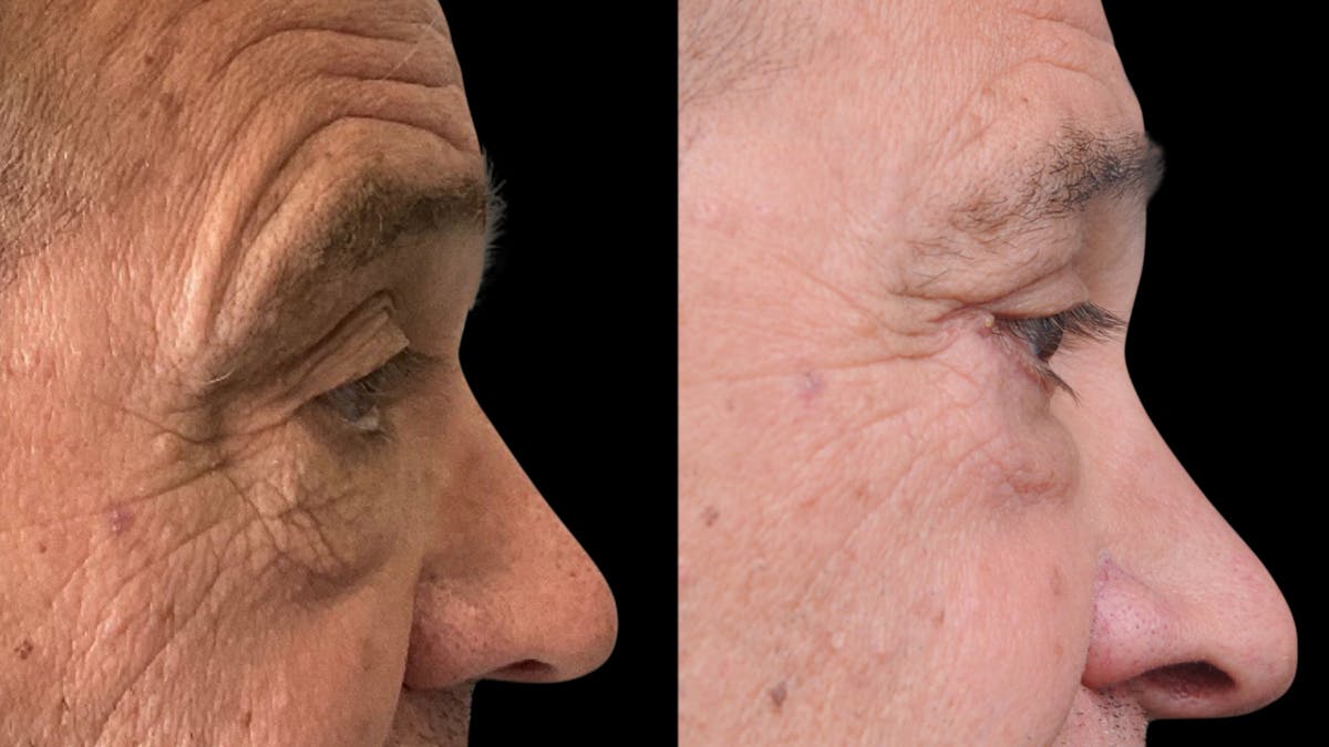 Upper & Lower Eyelid Surgery Before & After Gallery - Patient 147620 - Image 5