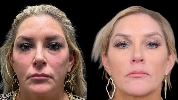 Upper & Lower Eyelid Surgery Before & After Gallery - Patient 301596 - Image 1