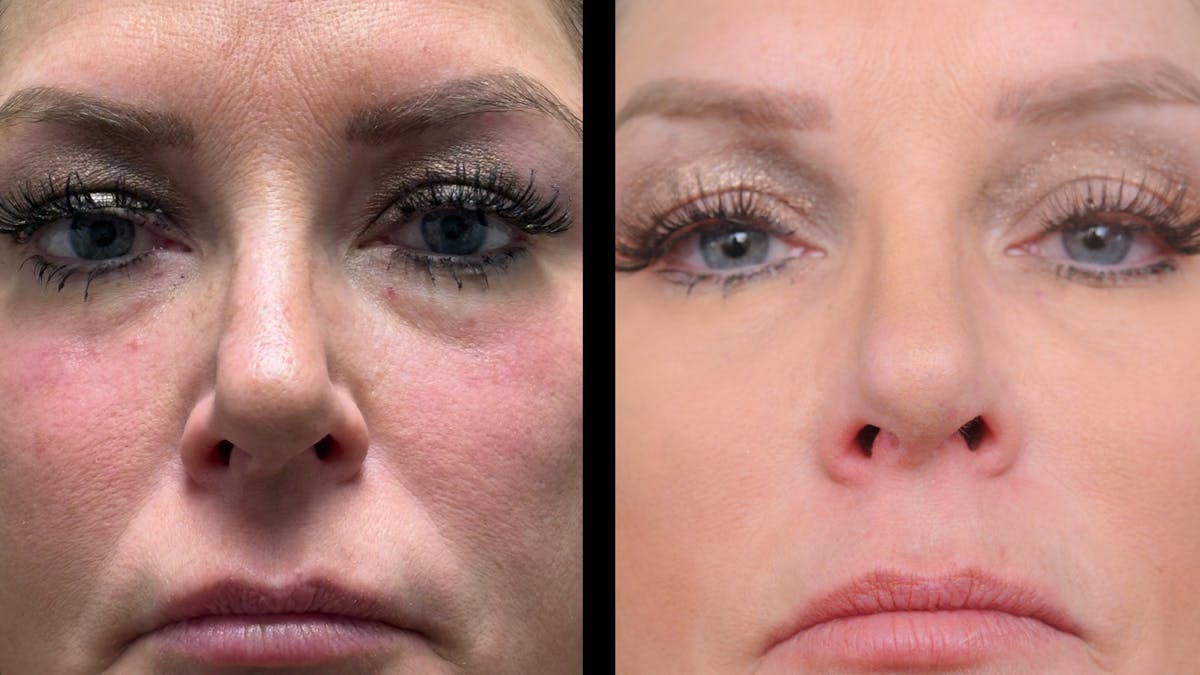 Upper & Lower Eyelid Surgery Before & After Gallery - Patient 301596 - Image 2
