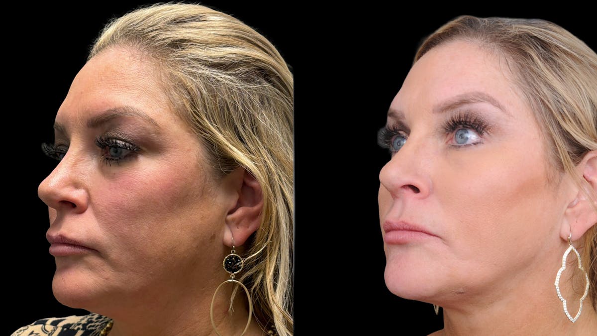Upper & Lower Eyelid Surgery Before & After Gallery - Patient 301596 - Image 3