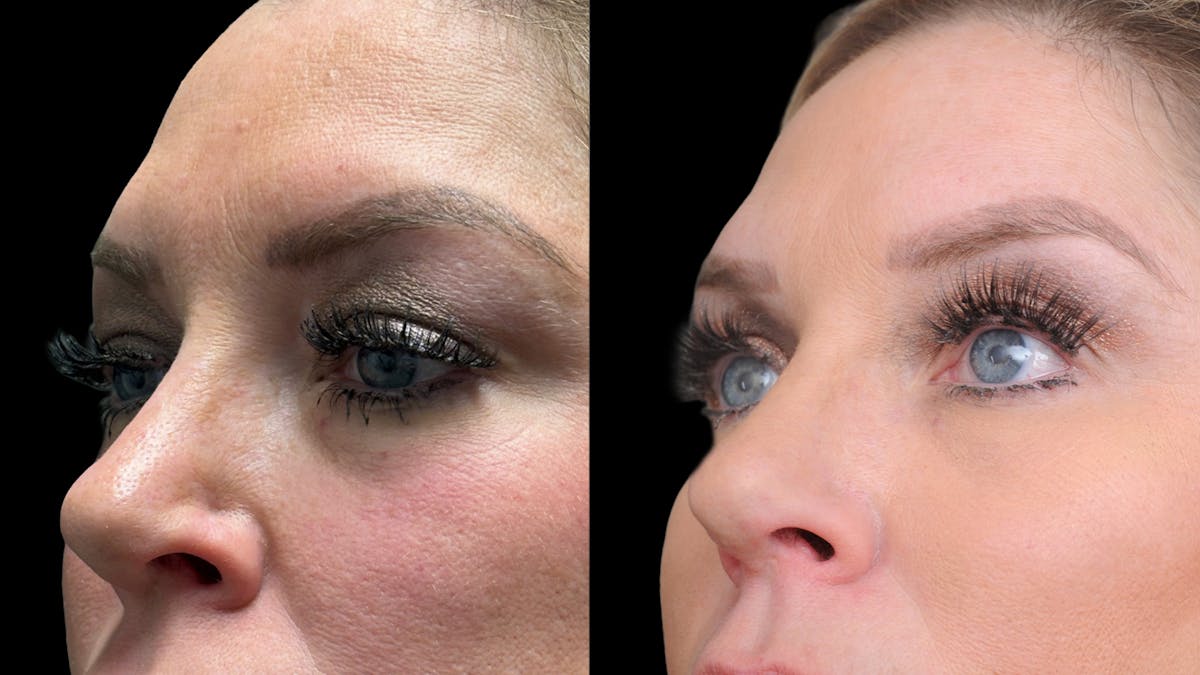 Upper & Lower Eyelid Surgery Before & After Gallery - Patient 301596 - Image 4