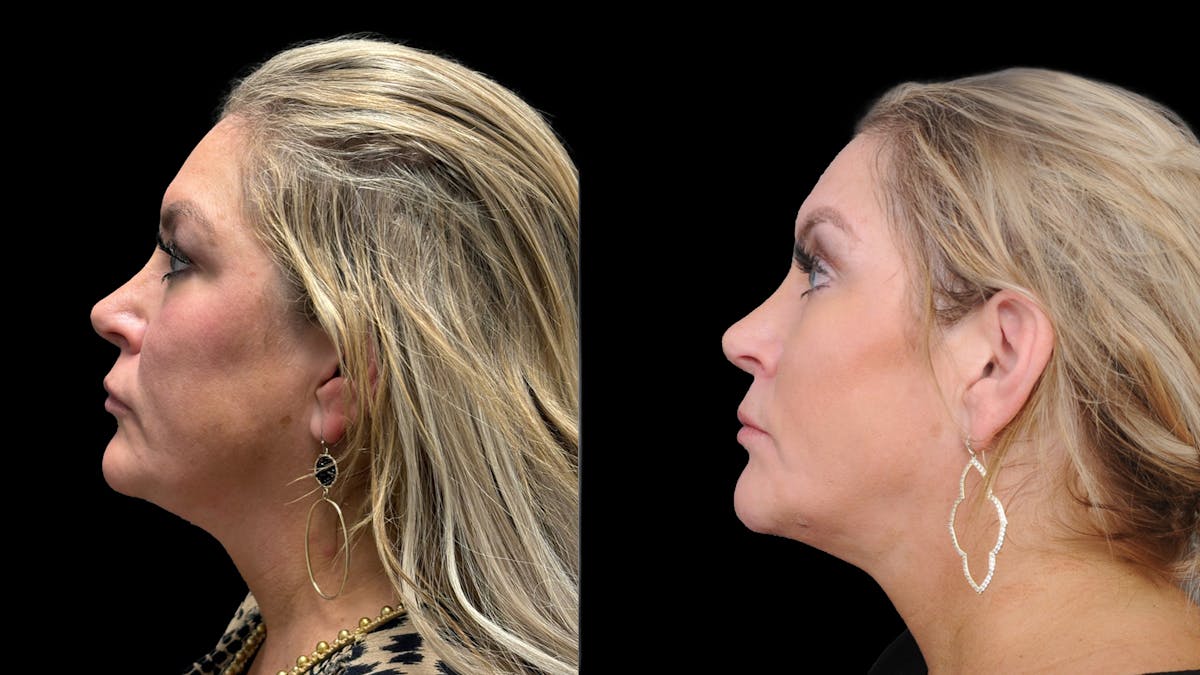 Upper & Lower Eyelid Surgery Before & After Gallery - Patient 301596 - Image 5