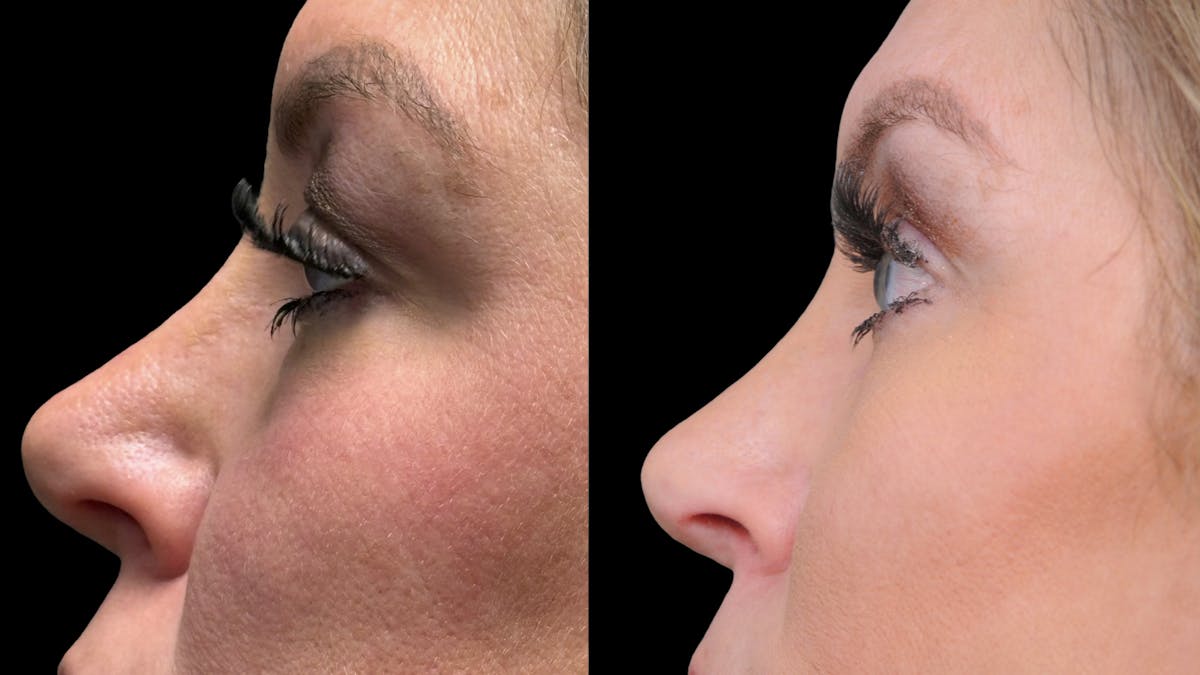 Upper & Lower Eyelid Surgery Before & After Gallery - Patient 301596 - Image 6