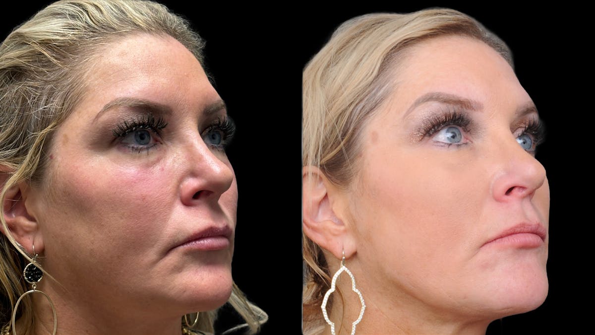 Upper & Lower Eyelid Surgery Before & After Gallery - Patient 301596 - Image 7