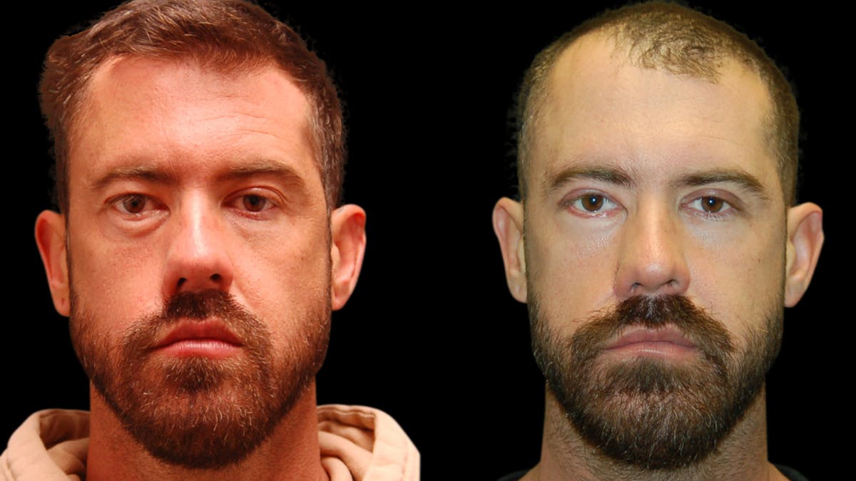 Upper & Lower Eyelid Surgery Before & After Gallery - Patient 424574 - Image 1