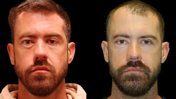 Upper & Lower Eyelid Surgery Before & After Gallery - Patient 424574 - Image 1