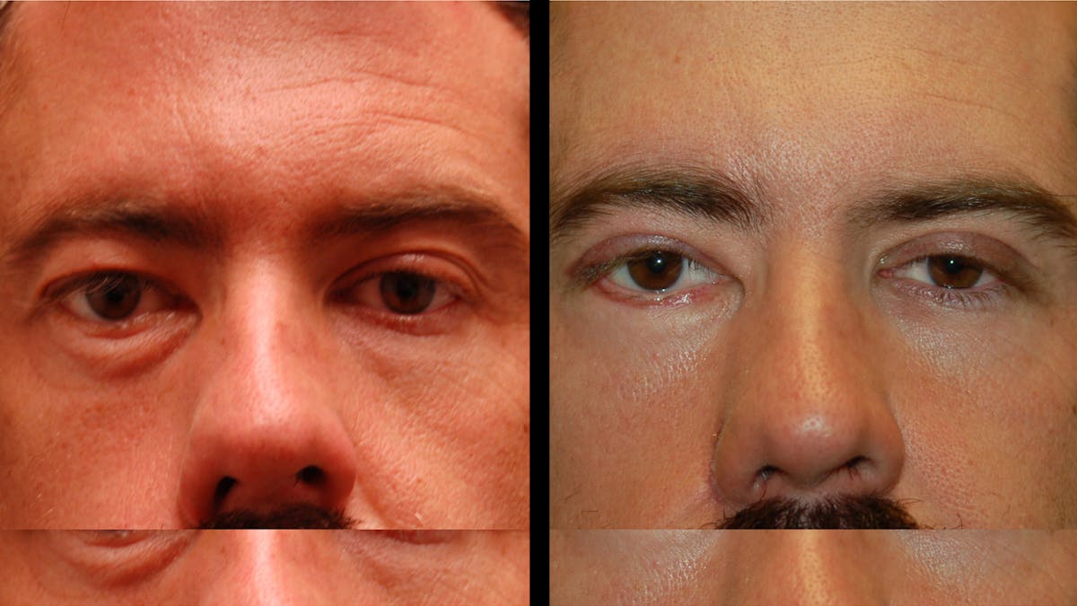 Upper & Lower Eyelid Surgery Before & After Gallery - Patient 424574 - Image 2