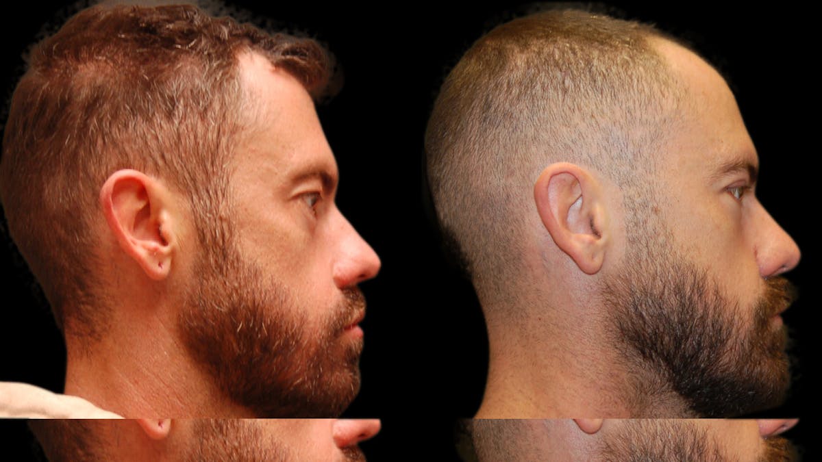 Upper & Lower Eyelid Surgery Before & After Gallery - Patient 424574 - Image 4