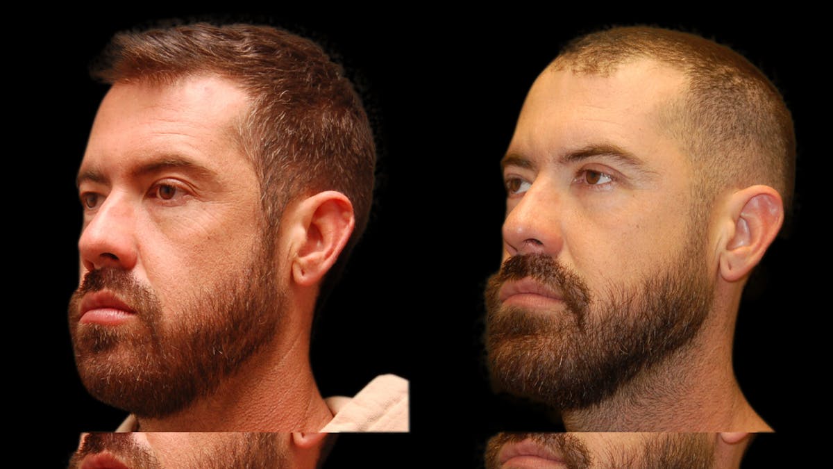 Upper & Lower Eyelid Surgery Before & After Gallery - Patient 424574 - Image 5