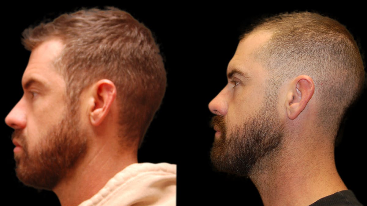 Upper & Lower Eyelid Surgery Before & After Gallery - Patient 424574 - Image 6