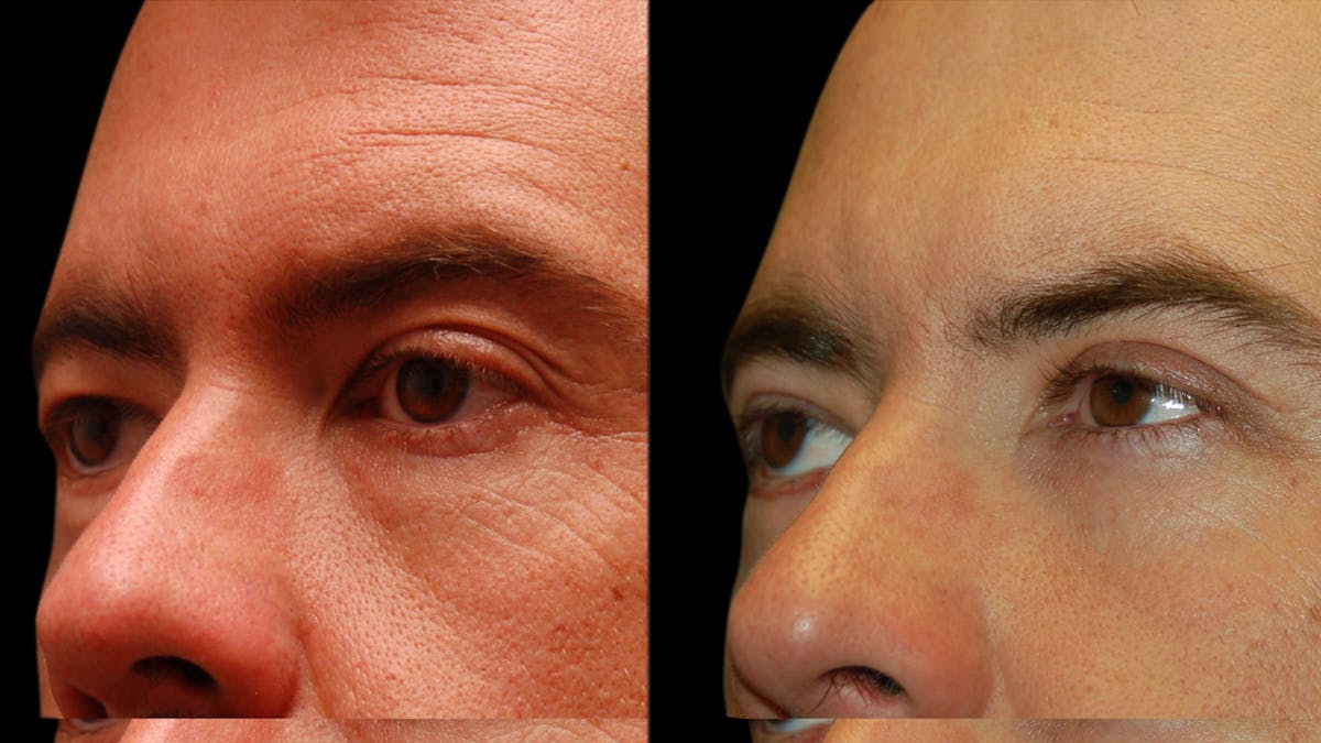 Upper & Lower Eyelid Surgery Before & After Gallery - Patient 424574 - Image 7