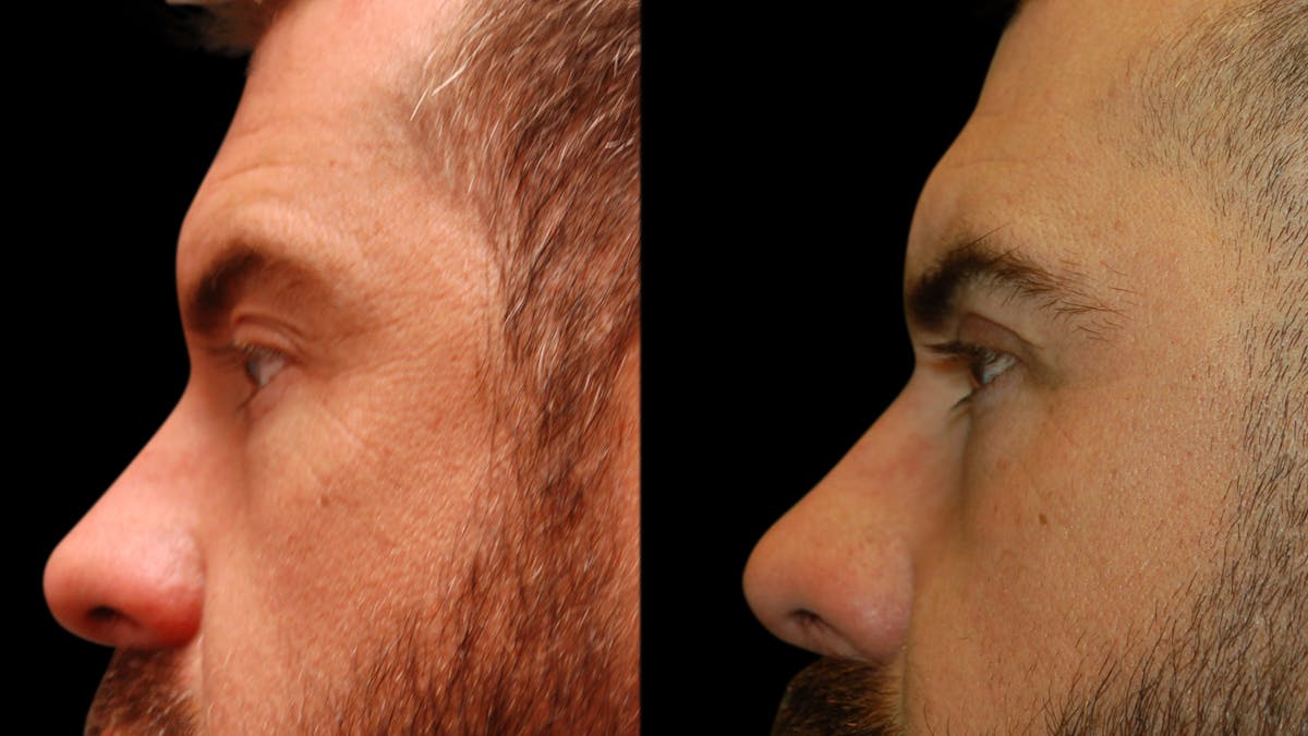 Upper & Lower Eyelid Surgery Before & After Gallery - Patient 424574 - Image 8