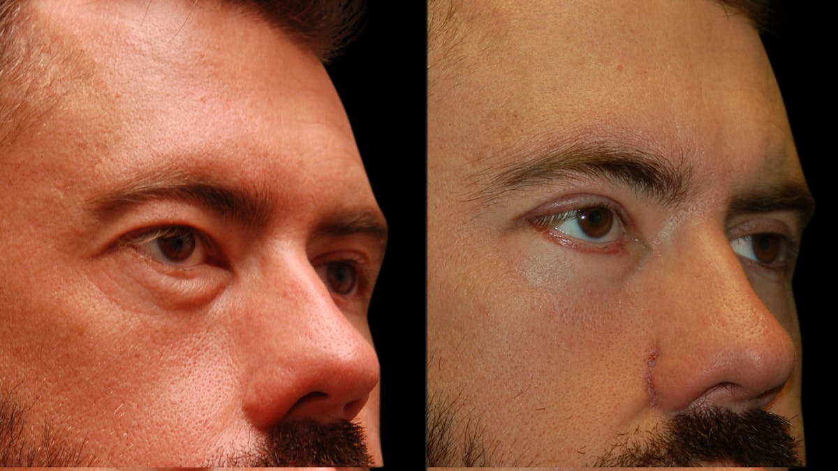 Upper & Lower Eyelid Surgery Before & After Gallery - Patient 424574 - Image 9