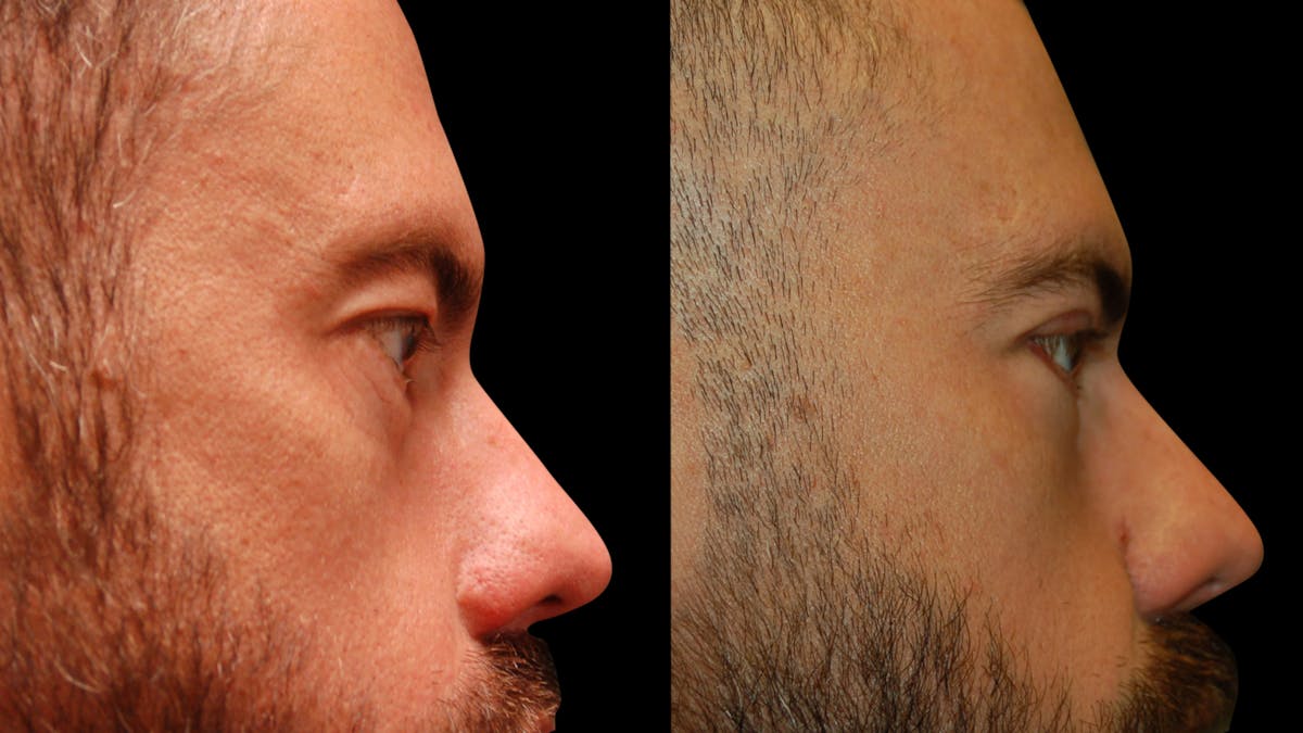 Upper & Lower Eyelid Surgery Before & After Gallery - Patient 424574 - Image 10