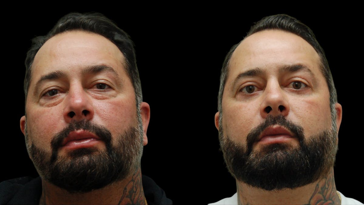 Upper & Lower Eyelid Surgery Before & After Gallery - Patient 184201 - Image 1