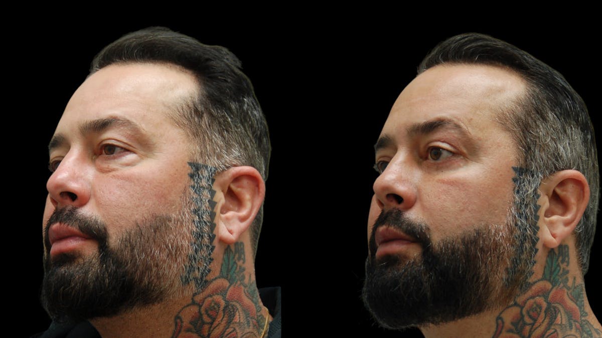 Upper & Lower Eyelid Surgery Before & After Gallery - Patient 184201 - Image 2