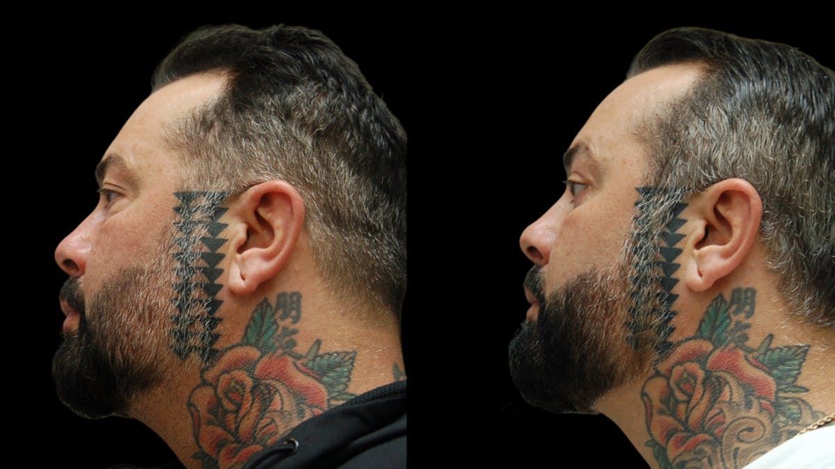 Upper & Lower Eyelid Surgery Before & After Gallery - Patient 184201 - Image 3