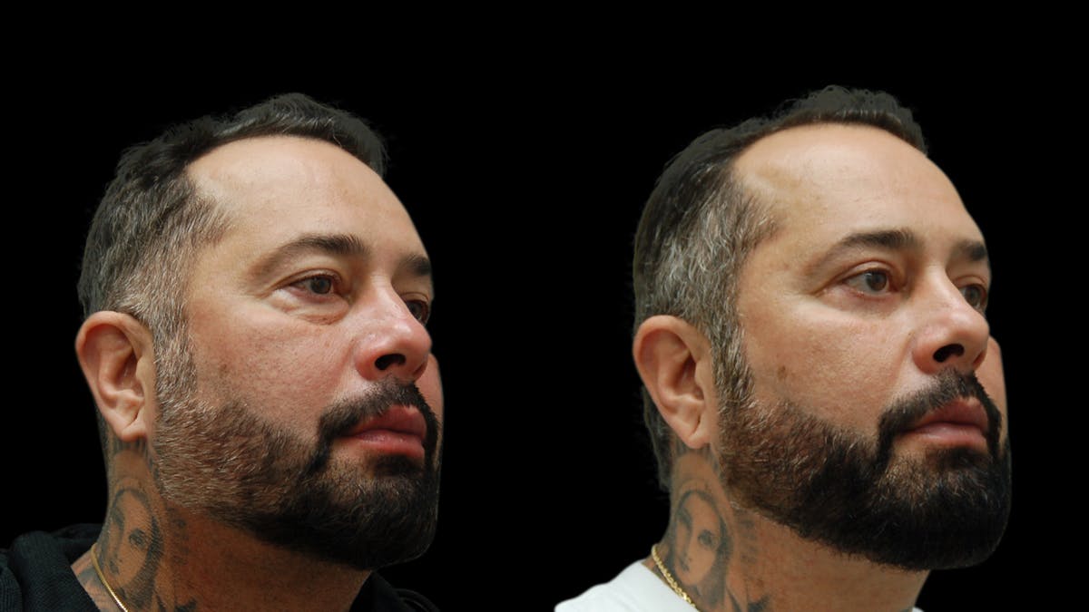 Upper & Lower Eyelid Surgery Before & After Gallery - Patient 184201 - Image 4