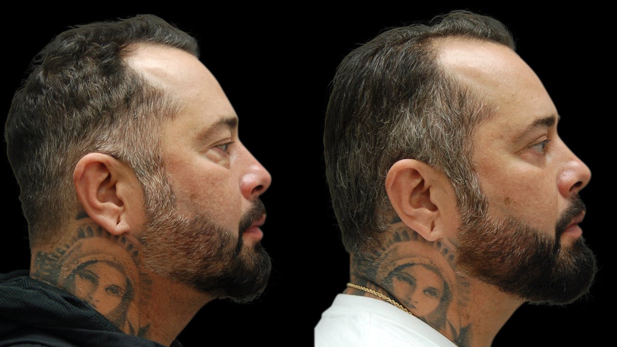 Upper & Lower Eyelid Surgery Before & After Gallery - Patient 184201 - Image 5