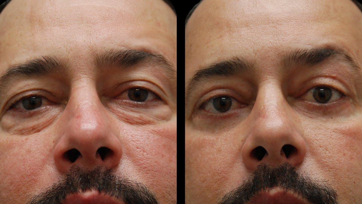 Upper & Lower Eyelid Surgery Before & After Gallery - Patient 184201 - Image 6