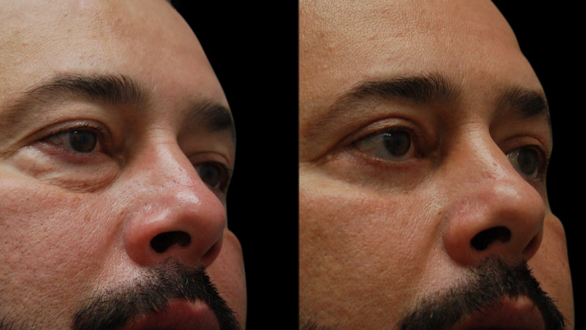 Upper & Lower Eyelid Surgery Before & After Gallery - Patient 184201 - Image 7
