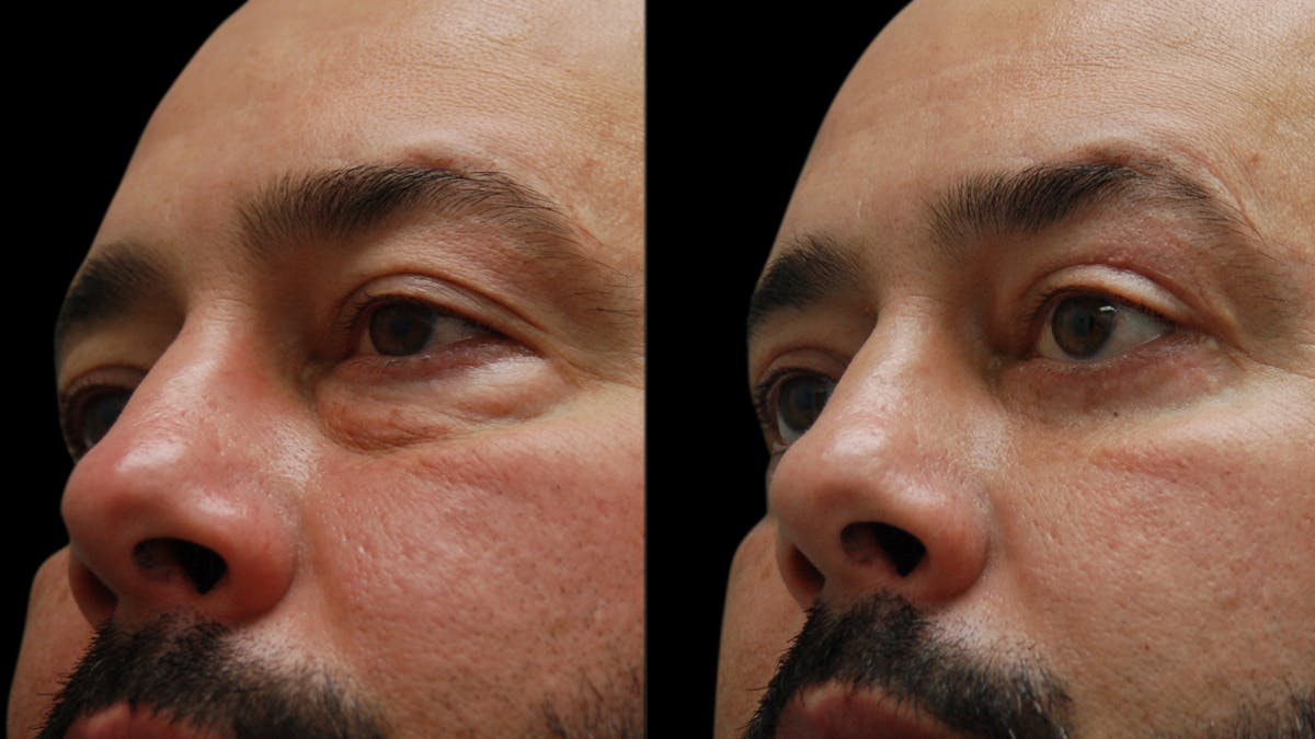 Upper & Lower Eyelid Surgery Before & After Gallery - Patient 184201 - Image 9