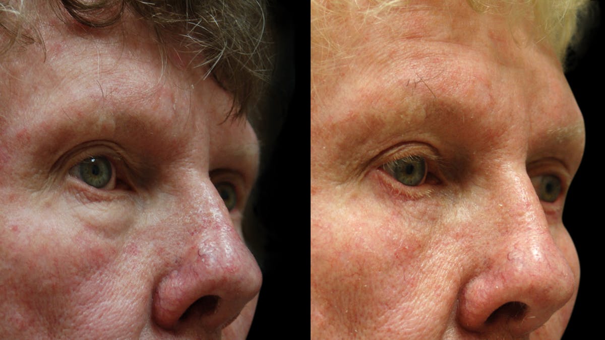 Upper & Lower Eyelid Surgery Before & After Gallery - Patient 374562 - Image 1