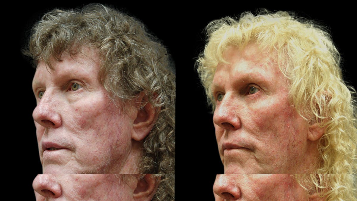 Upper & Lower Eyelid Surgery Before & After Gallery - Patient 374562 - Image 2