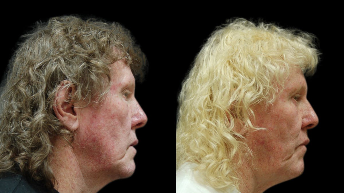 Upper & Lower Eyelid Surgery Before & After Gallery - Patient 374562 - Image 3