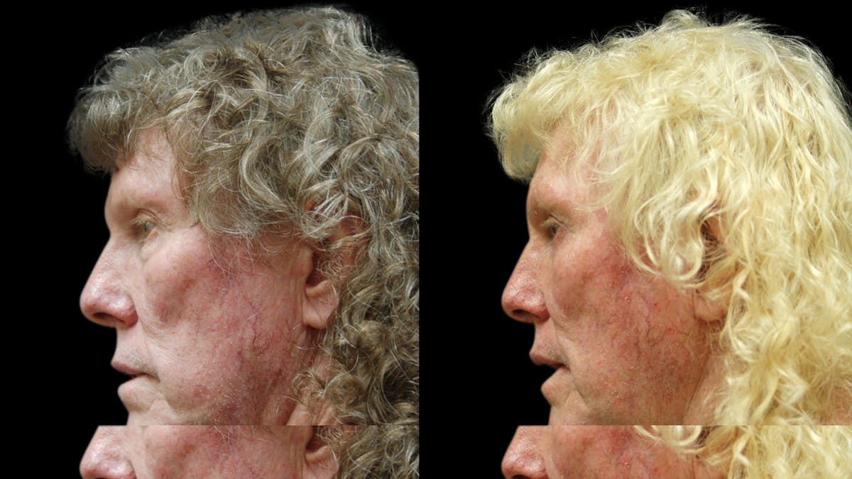 Upper & Lower Eyelid Surgery Before & After Gallery - Patient 374562 - Image 4