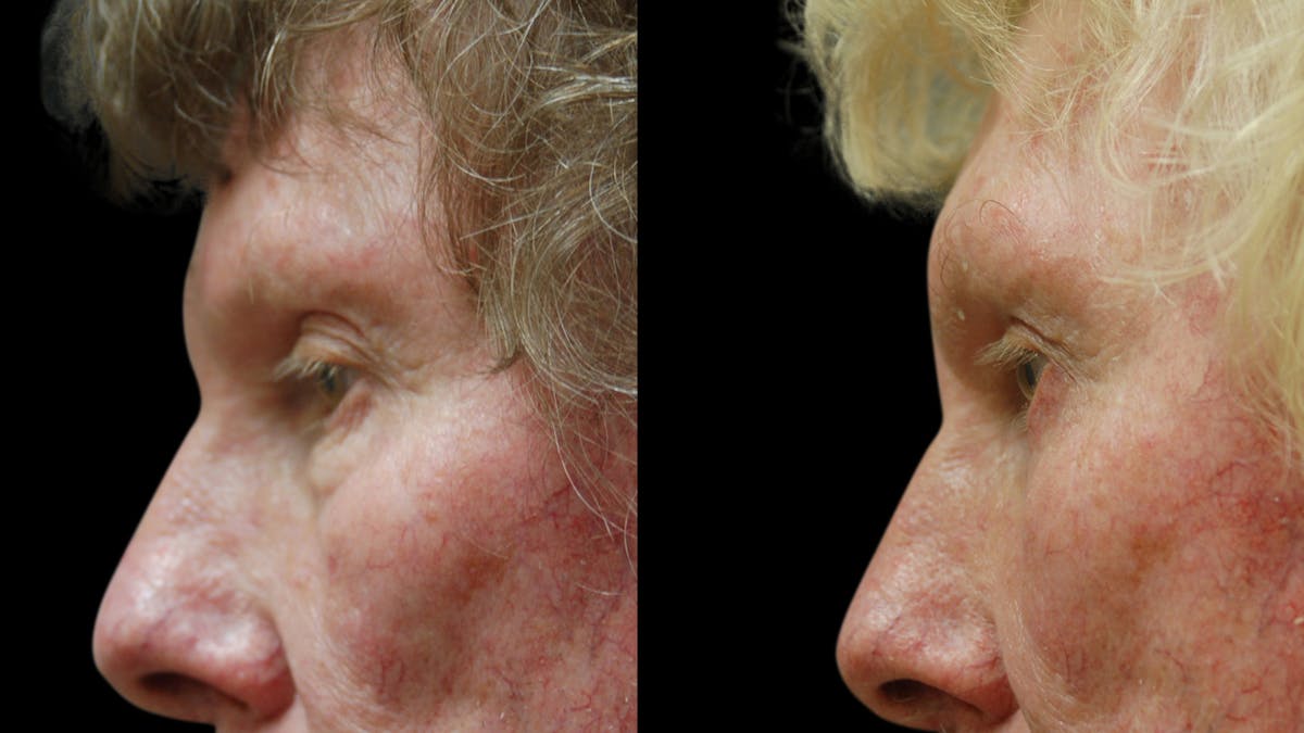 Upper & Lower Eyelid Surgery Before & After Gallery - Patient 374562 - Image 5