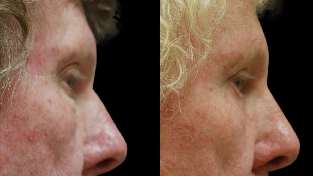 Upper & Lower Eyelid Surgery Before & After Gallery - Patient 374562 - Image 6