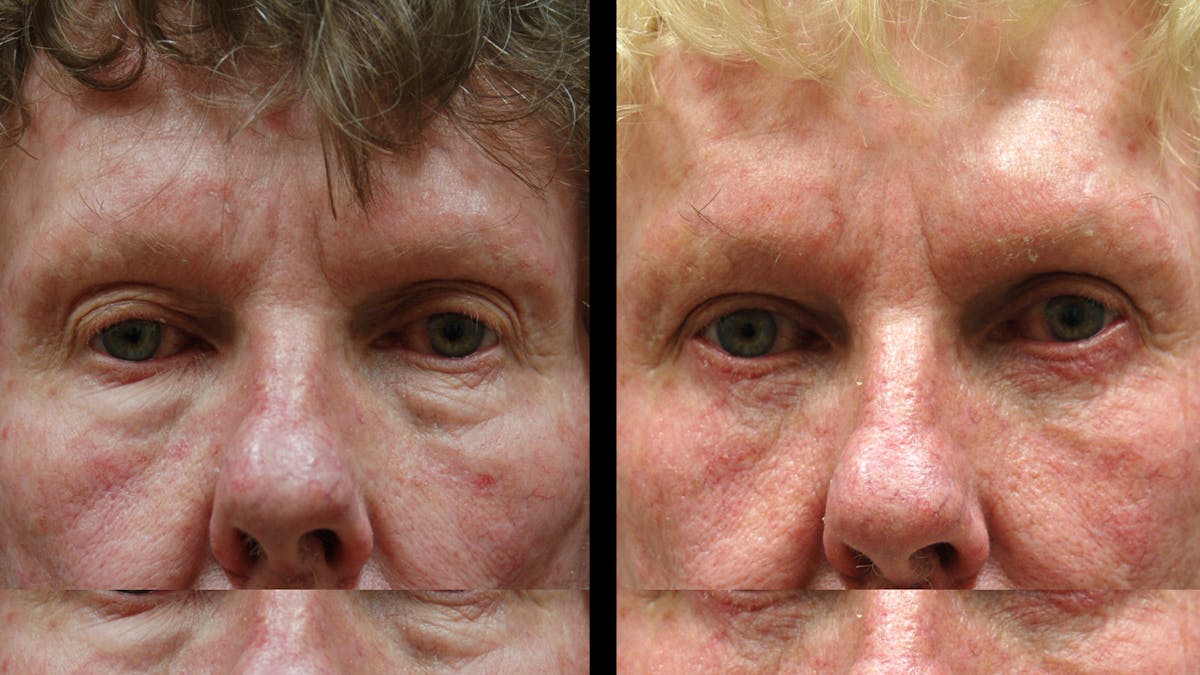 Upper & Lower Eyelid Surgery Before & After Gallery - Patient 374562 - Image 7