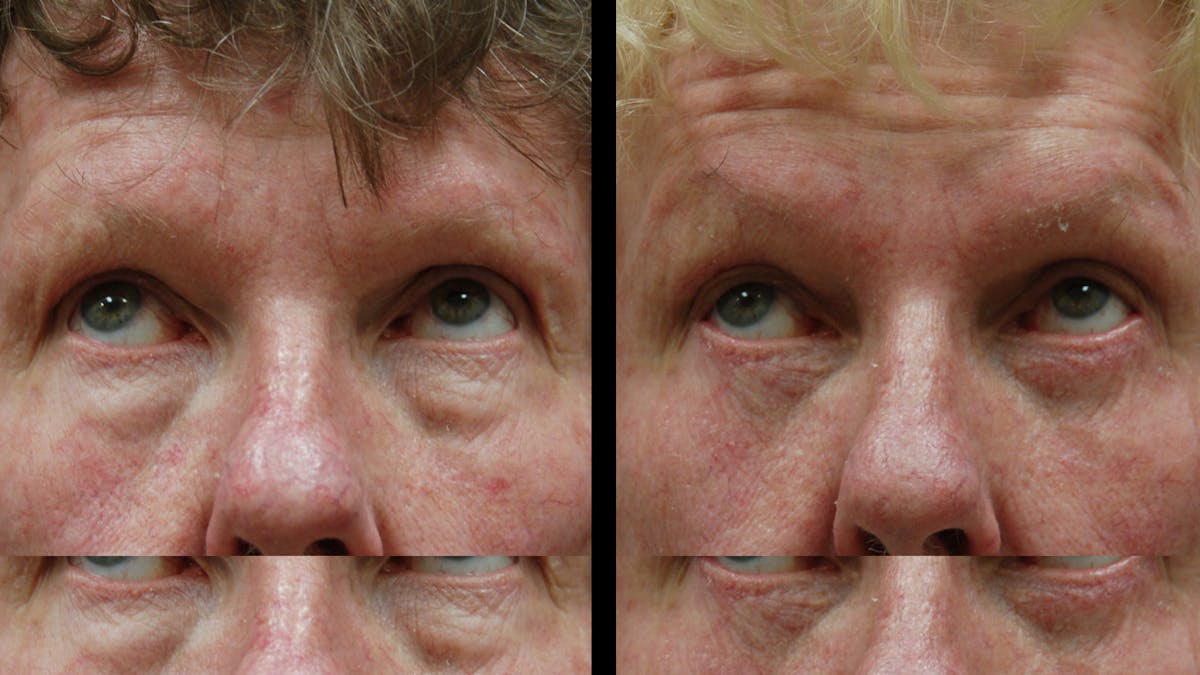 Upper & Lower Eyelid Surgery Before & After Gallery - Patient 374562 - Image 8