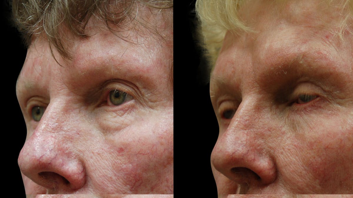 Upper & Lower Eyelid Surgery Before & After Gallery - Patient 374562 - Image 9