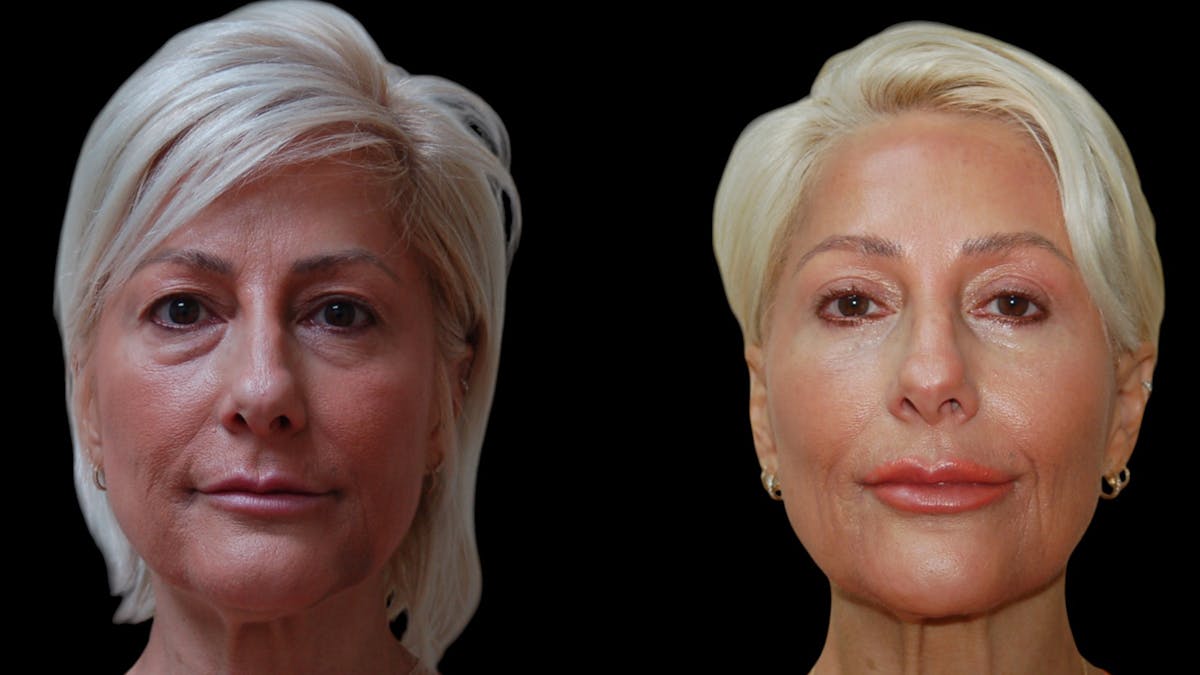 Upper & Lower Eyelid Surgery Before & After Gallery - Patient 168099 - Image 1