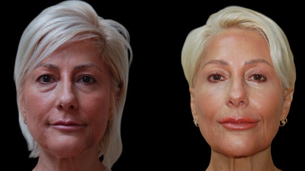 Upper & Lower Eyelid Surgery Before & After Gallery - Patient 168099 - Image 1