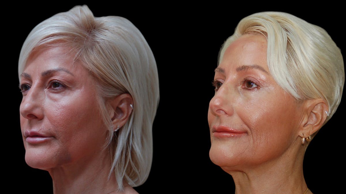 Upper & Lower Eyelid Surgery Before & After Gallery - Patient 168099 - Image 2