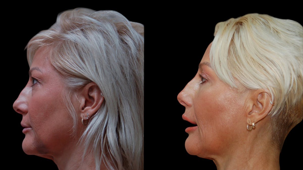 Upper & Lower Eyelid Surgery Before & After Gallery - Patient 168099 - Image 3