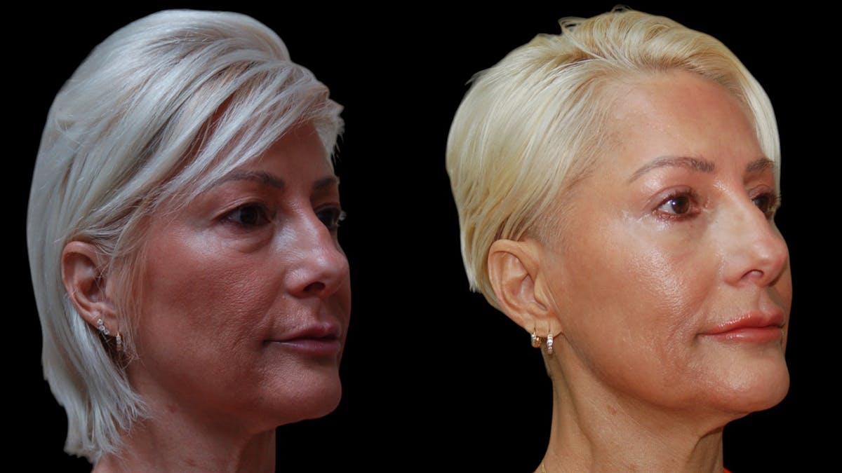 Upper & Lower Eyelid Surgery Before & After Gallery - Patient 168099 - Image 4