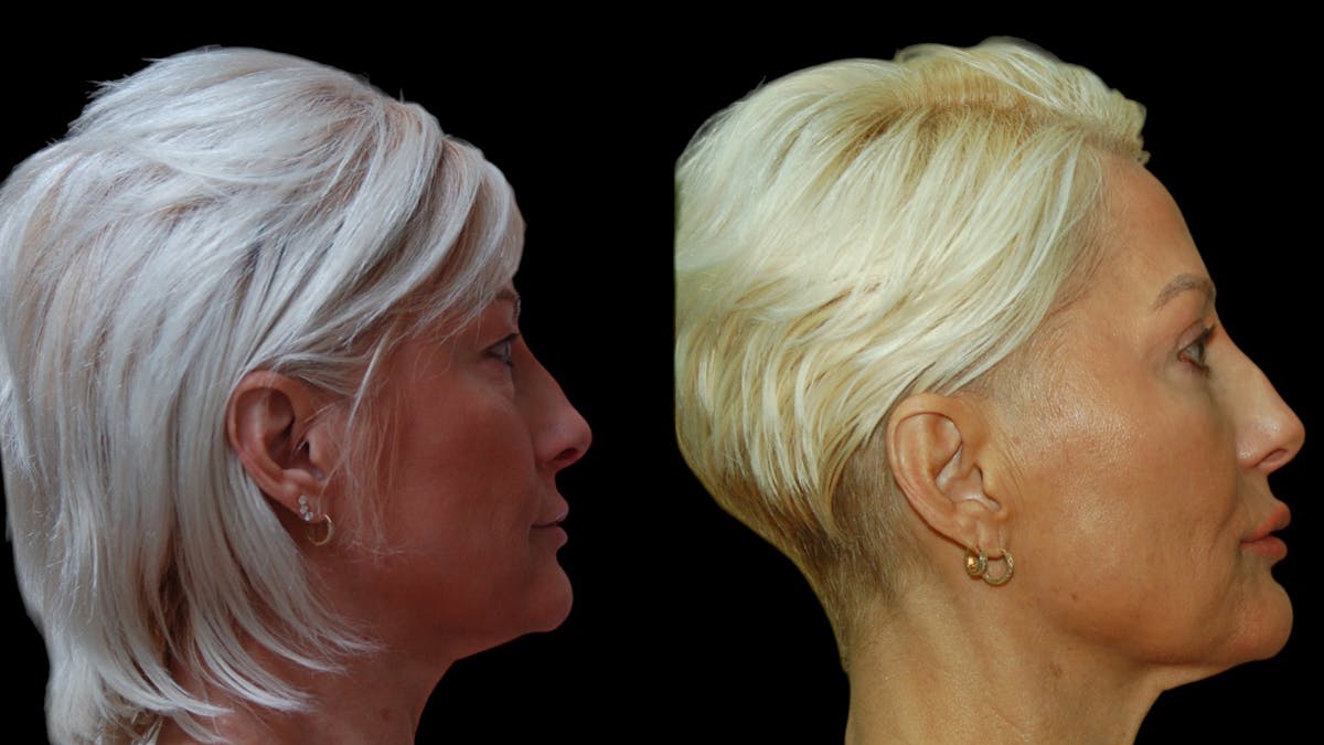 Upper & Lower Eyelid Surgery Before & After Gallery - Patient 168099 - Image 5
