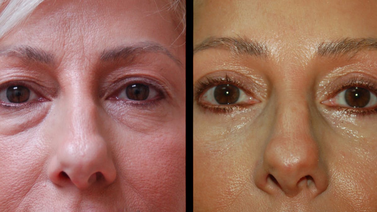 Upper & Lower Eyelid Surgery Before & After Gallery - Patient 168099 - Image 6