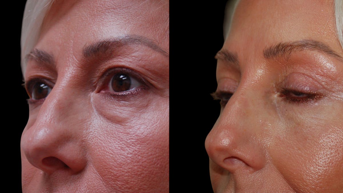Upper & Lower Eyelid Surgery Before & After Gallery - Patient 168099 - Image 7