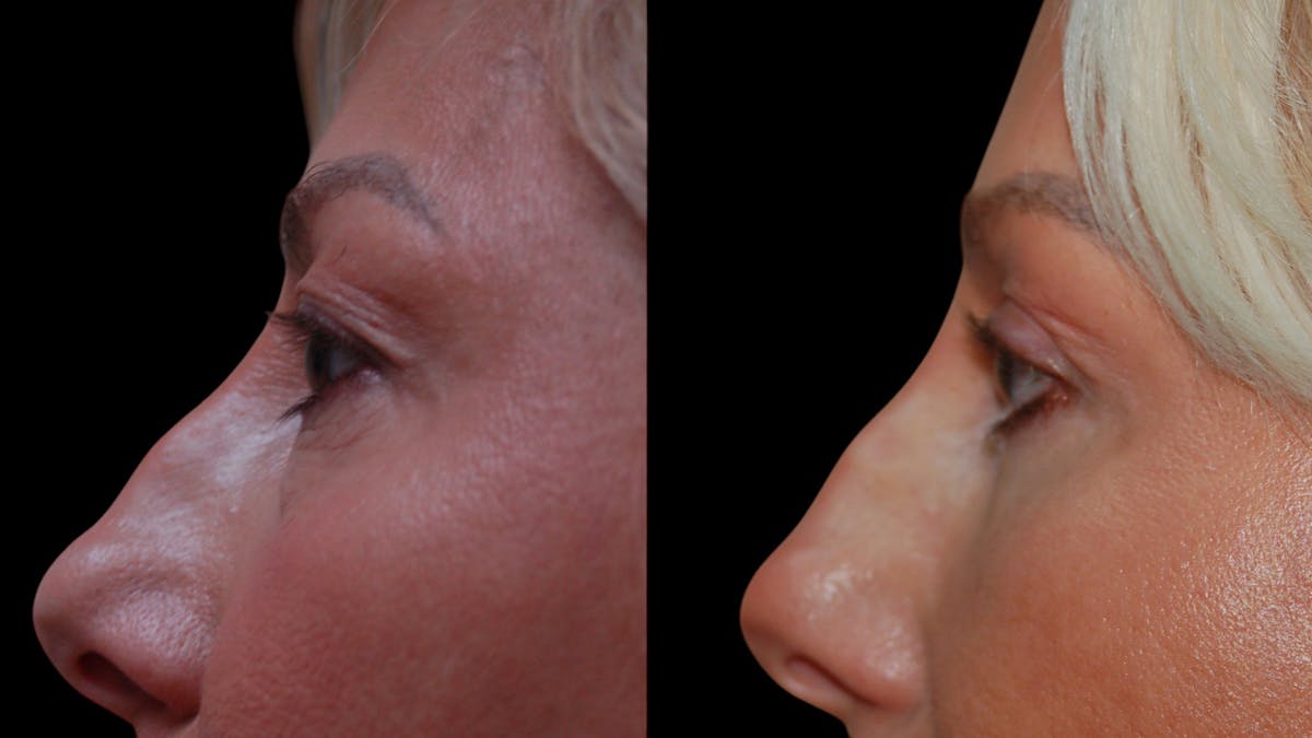 Upper & Lower Eyelid Surgery Before & After Gallery - Patient 168099 - Image 8