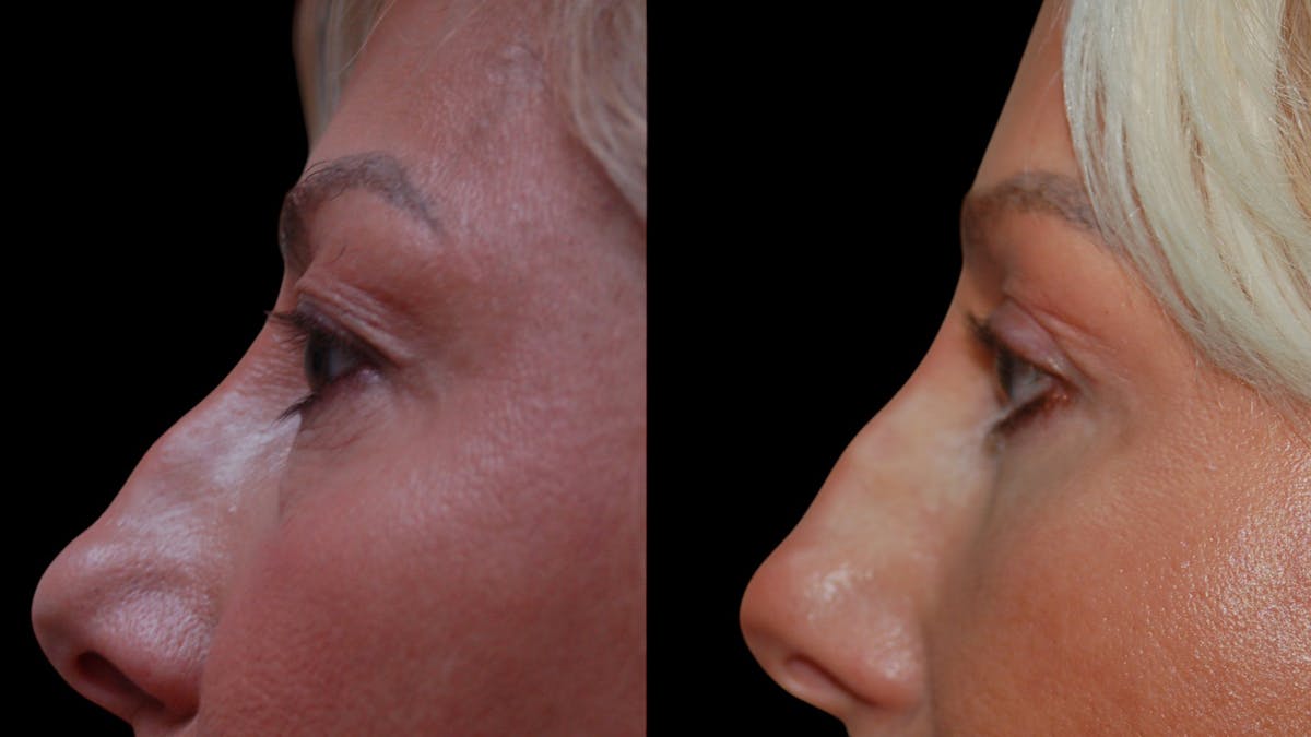 Upper & Lower Eyelid Surgery Before & After Gallery - Patient 168099 - Image 9