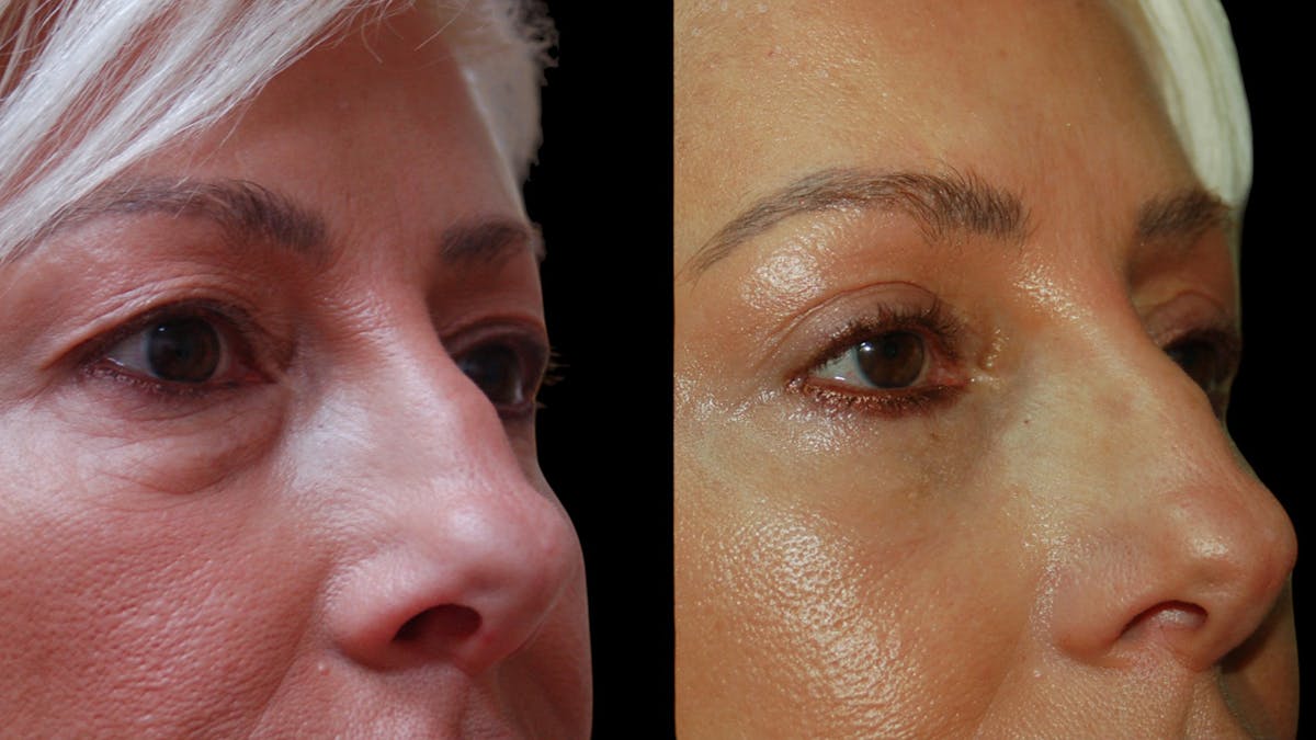 Upper & Lower Eyelid Surgery Before & After Gallery - Patient 168099 - Image 10