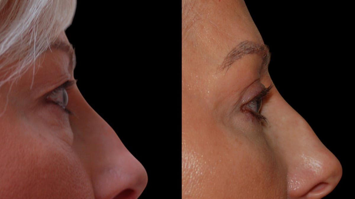 Upper & Lower Eyelid Surgery Before & After Gallery - Patient 168099 - Image 11
