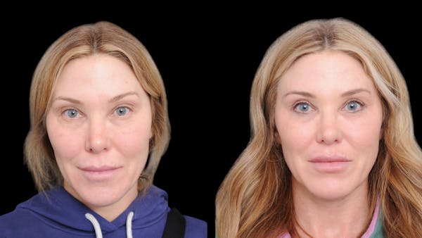 Upper & Lower Eyelid Surgery Before & After Gallery - Patient 169152 - Image 1