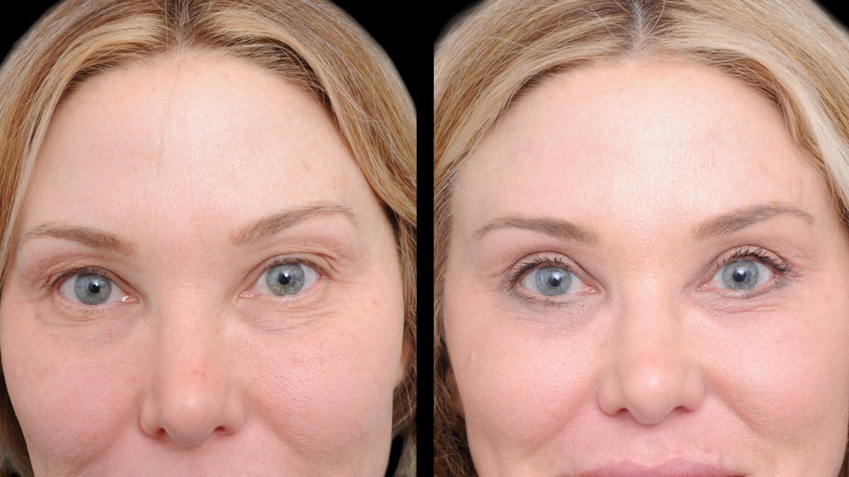 Upper & Lower Eyelid Surgery Before & After Gallery - Patient 169152 - Image 2
